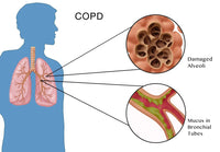 Chronic Obstructive Pulmonary Disease (COPD) Fine Art Print by Science Source