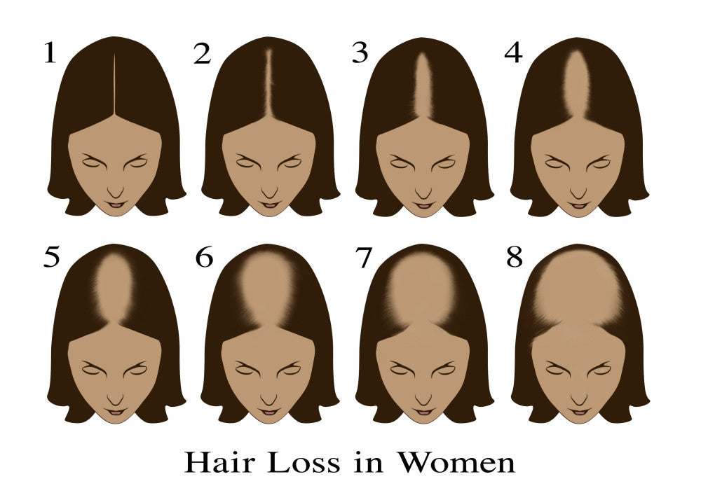 Hair Loss Educational Poster Print by Science Source