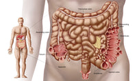 Diverticulitis Illustration Fine Art Print - Descending Colon Anatomy