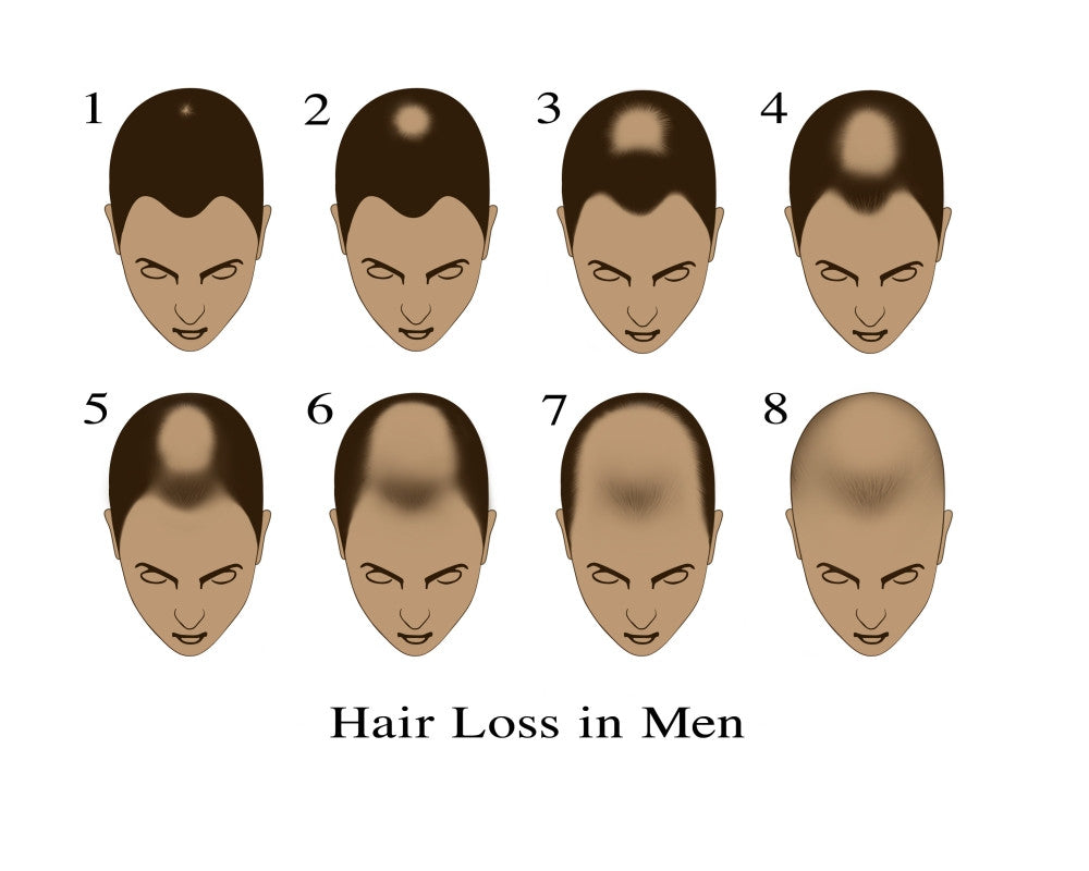 Hair Loss Fine Art Print by Gwen Shockey | Science Source