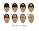 Hair Loss Fine Art Print by Gwen Shockey | Science Source