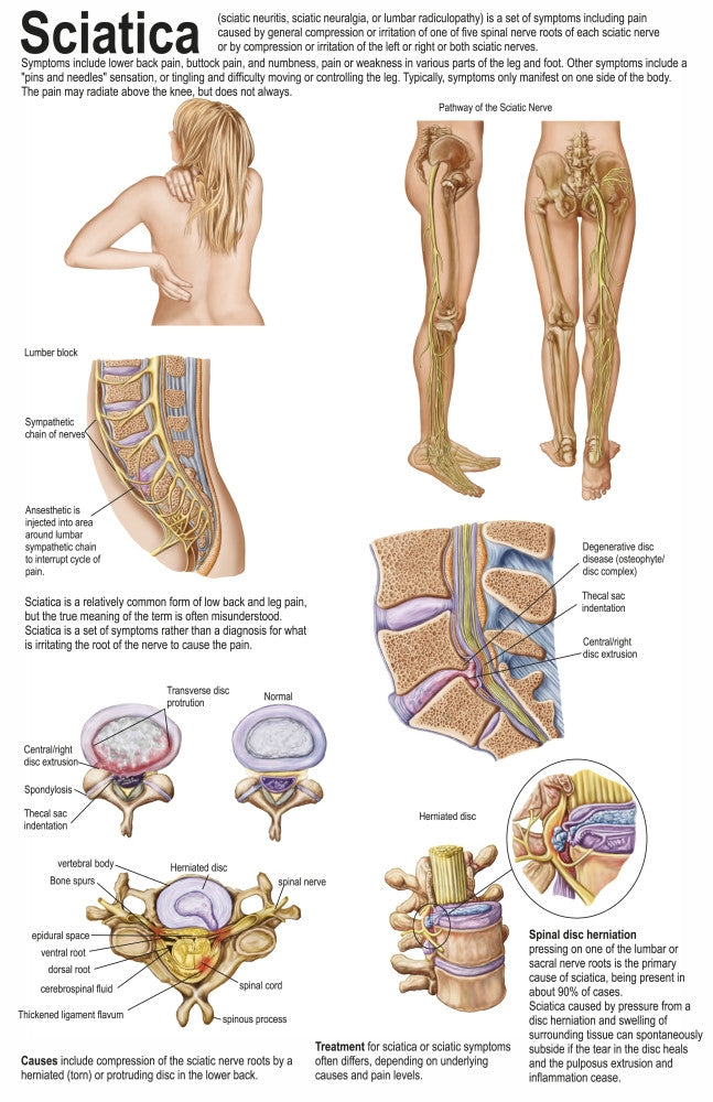 Sciatica Symptoms Medical Chart Poster Print - 11x17 & 22x35