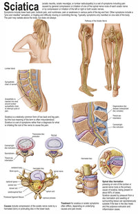Sciatica Symptoms Medical Chart Poster Print - 11x17 & 22x35