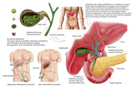 Cholecystectomy Medical Illustration Poster Print - Gallstones in Gallbladder