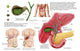 Cholecystectomy Medical Illustration Poster Print - Gallstones in Gallbladder