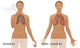 Lungs of Smoker vs. Non-Smoker Fine Art Print by Gwen Shockey