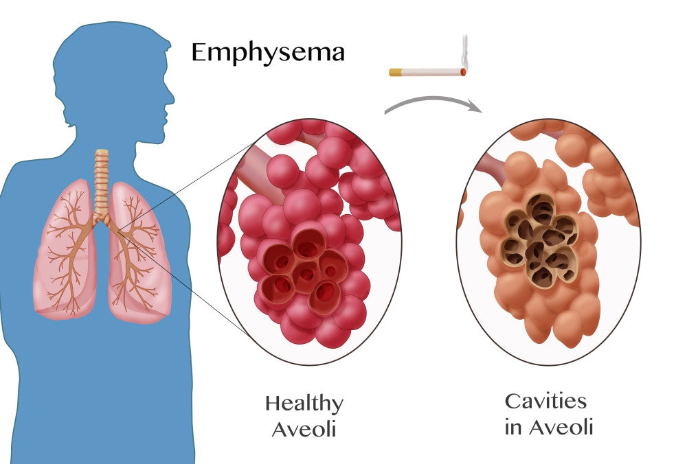 Alveoli Comparison and Emphysema Fine Art Print by Science Source