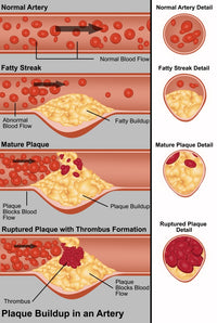 Plaque in Artery Fine Art Print by Gwen Shockey | Science Source
