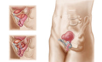 Anatomy of Bladder Suspension Procedure Poster Print for Urinary Incontinence