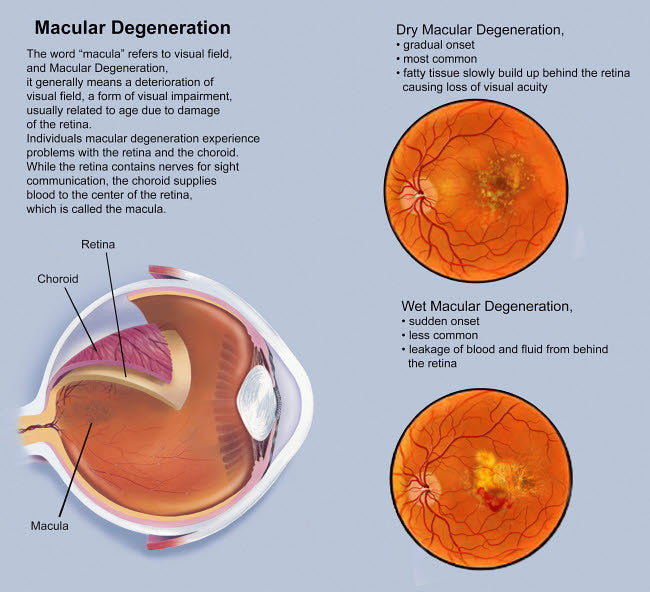 Retina with Macular Degeneration Fine Art Print by TriFocal Communications