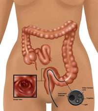 Colonoscopy Fine Art Print by Gwen Shockey | Science Source