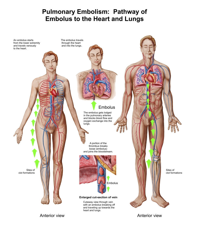 Pulmonary Embolism Pathway Fine Art Print - Medical Illustration