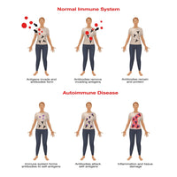 Normal Immune System & Autoimmune Disease Fine Art Print by Gwen Shockey