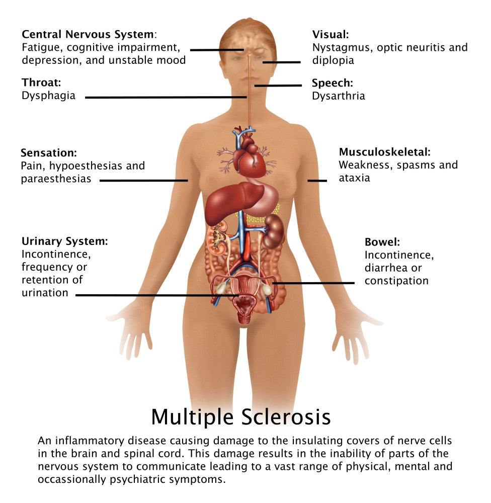 Symptoms of Multiple Sclerosis Fine Art Print by Gwen Shockey