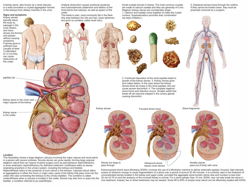 Kidney Stones Medical Chart Poster Print - Signs & Symptoms
