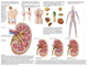 Kidney Stones Medical Chart Poster Print - Signs & Symptoms