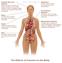 Effects of Cocaine Use Fine Art Print by Science Source