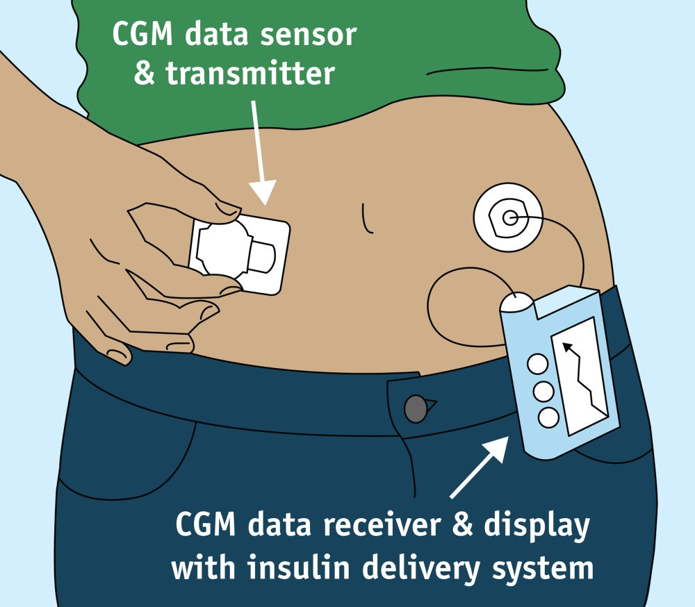 Continuous Glucose Monitor Fine Art Print by Science Source