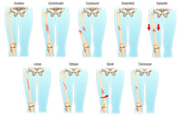 Types of Bone Fractures Educational Poster Print by Evan Oto