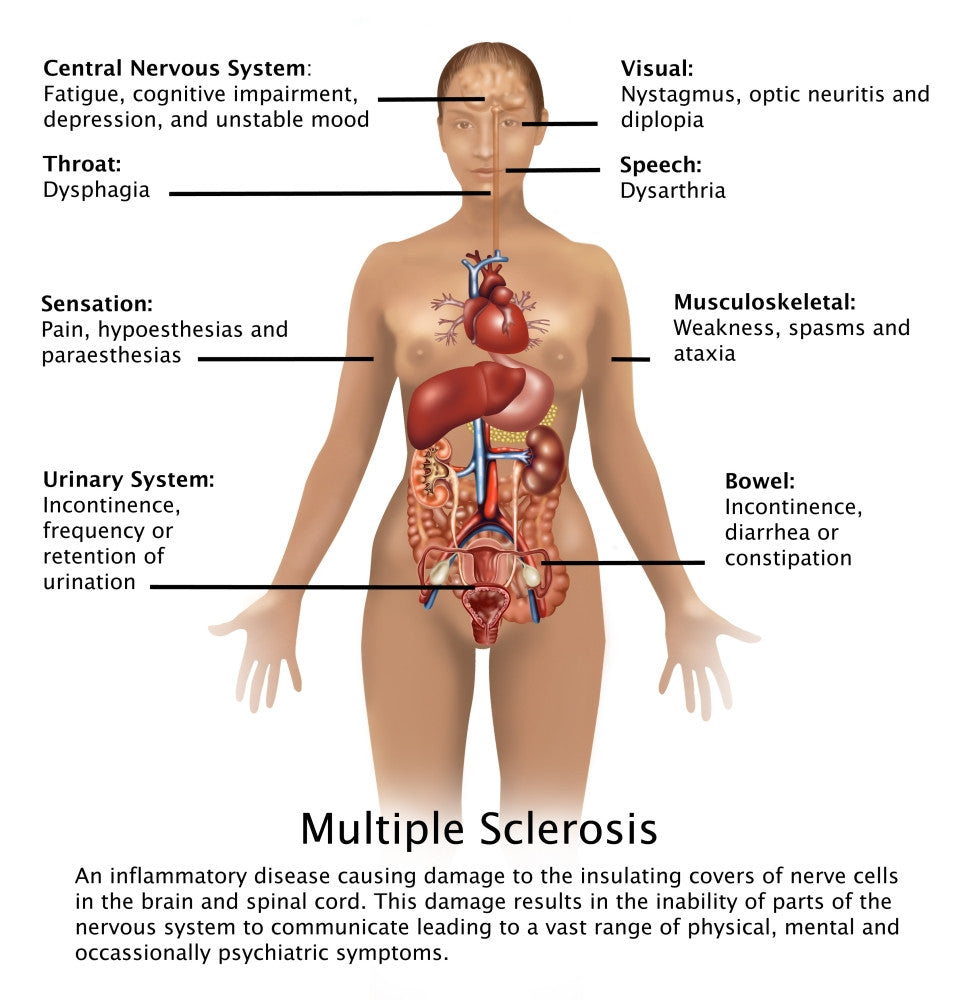 Symptoms of Multiple Sclerosis Fine Art Print by Gwen Shockey