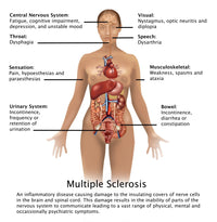 Symptoms of Multiple Sclerosis Fine Art Print by Gwen Shockey
