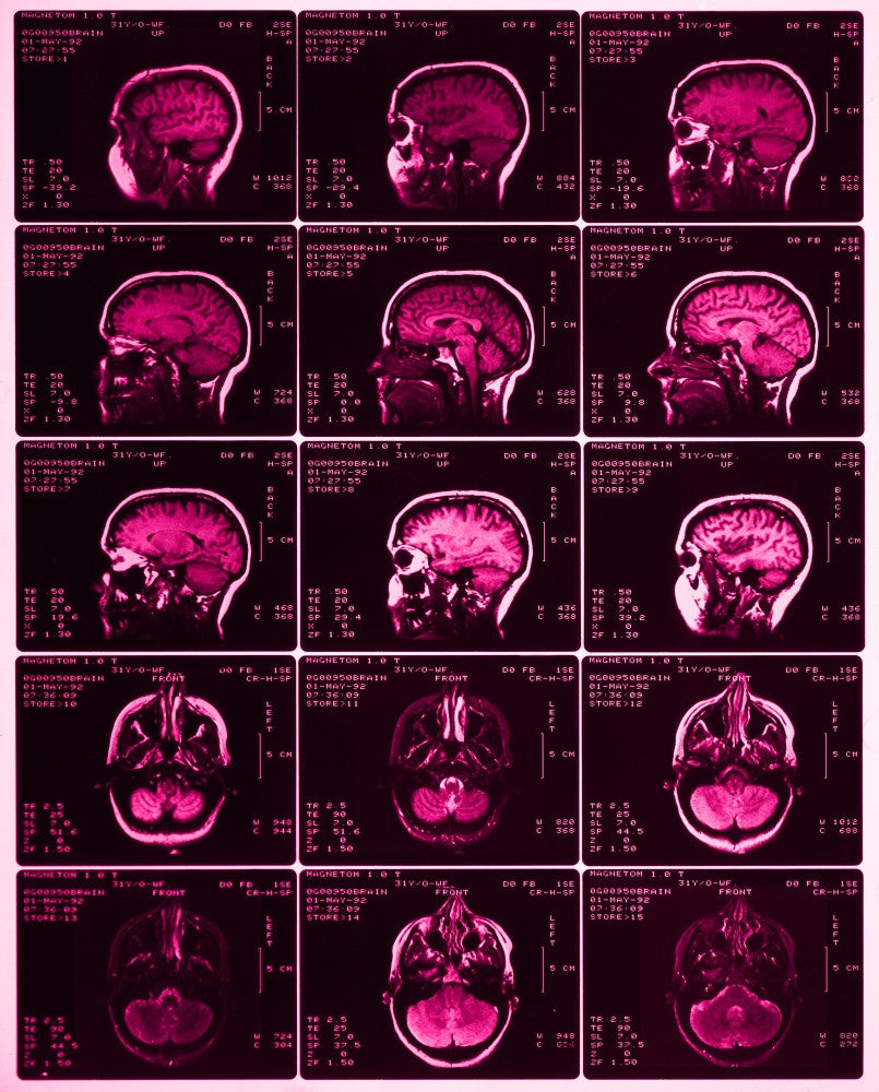MRI of Normal Brain Fine Art Print by Science Source
