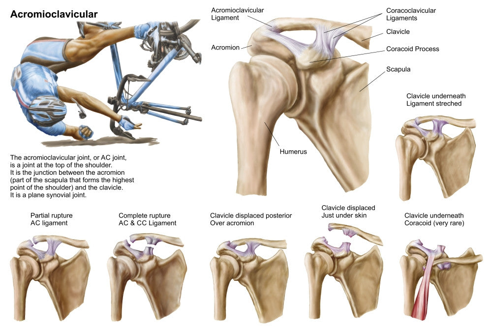 Anatomy of Acromioclavicular Joint Rupture Poster Print