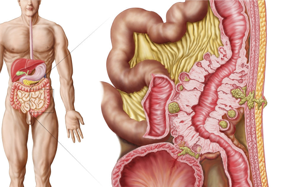 Illustration of Diverticulosis in the Colon Fine Art Print