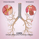 Chronic Obstructive Pulmonary Disease Fine Art Print by Monica Schroeder
