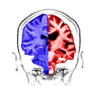 Normal vs. Alzheimer's Brain Comparison Fine Art Print by Science Source