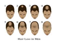 Hair Loss Fine Art Print by Gwen Shockey | Science Source