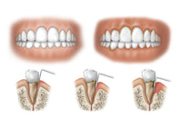 Three Stages of Periodontal Disease Fine Art Print by TriFocal Communications