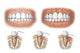 Three Stages of Periodontal Disease Fine Art Print by TriFocal Communications