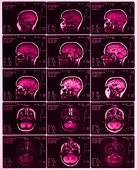 MRI of Normal Brain Fine Art Print by Science Source