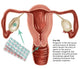 Birth Control Pill Fine Art Print by Gwen Shockey | Science Source