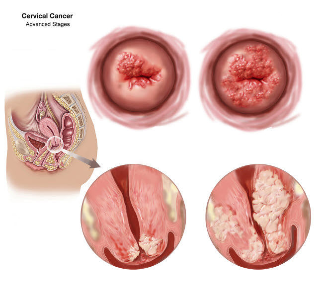 Advanced Cervical Cancer Fine Art Print - Sagittal and Vaginal Views by TriFocal Communications