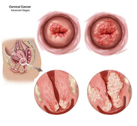 Advanced Cervical Cancer Fine Art Print - Sagittal and Vaginal Views by TriFocal Communications