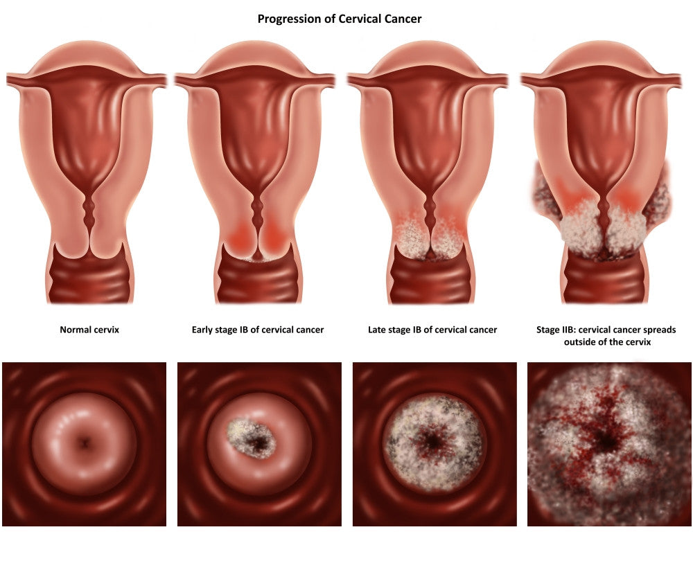 Cervical Cancer Awareness Fine Art Print by Gwen Shockey