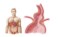 Medical Illustration of Hiatal Hernia Fine Art Print - 17x11, 35x22