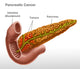 Pancreatic Cancer Illustration Fine Art Print by Spencer Sutton