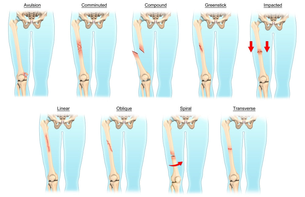 Types of Bone Fractures Educational Poster Print by Evan Oto