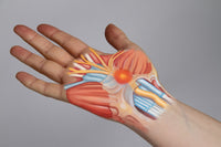 Carpal Tunnel Syndrome Fine Art Print by Spencer Sutton | Science Source