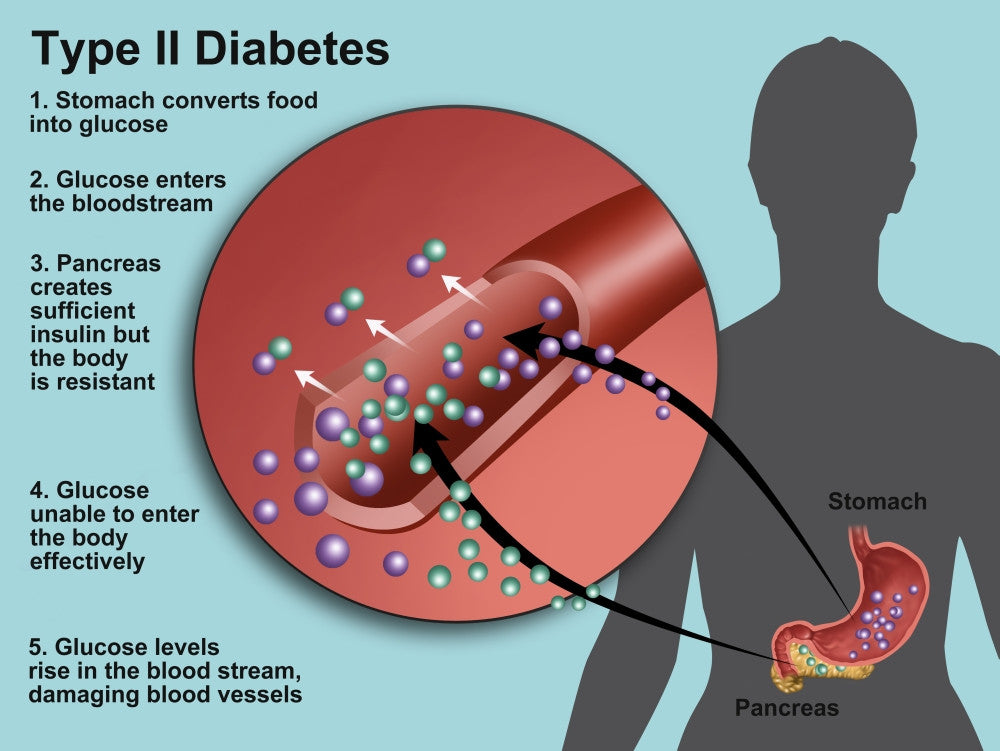 Type 2 Diabetes Educational Poster Print by Science Source