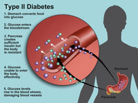 Type 2 Diabetes Educational Poster Print by Science Source