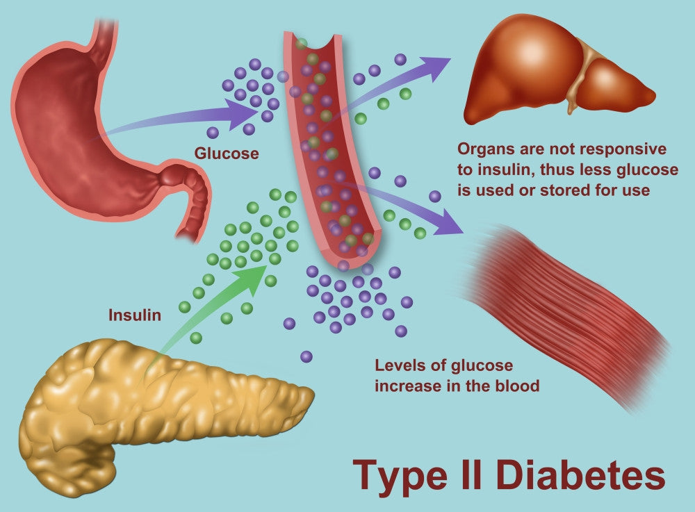 Type 2 Diabetes Educational Poster Print by Gwen Shockey