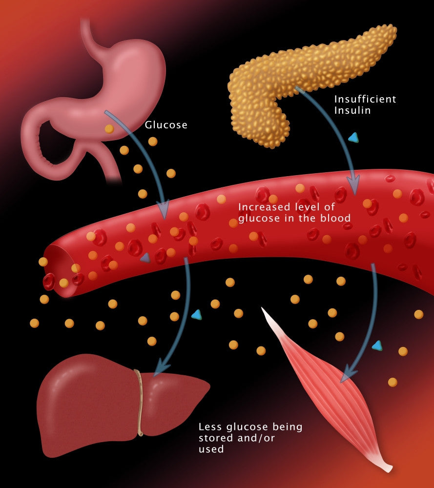 Type I Diabetes Educational Poster Print by Science Source