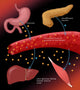 Type I Diabetes Educational Poster Print by Science Source