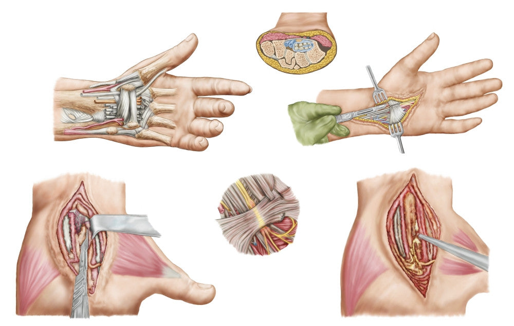 Carpal Tunnel Syndrome Medical Illustration Poster Print