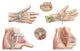 Carpal Tunnel Syndrome Medical Illustration Poster Print