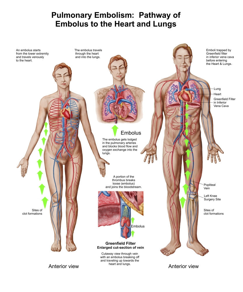 Pulmonary Embolism Pathway Fine Art Print - Embolus to Heart & Lungs